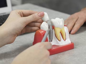 Dental Bridges vs. Implants: Choosing Your Tooth Replacement