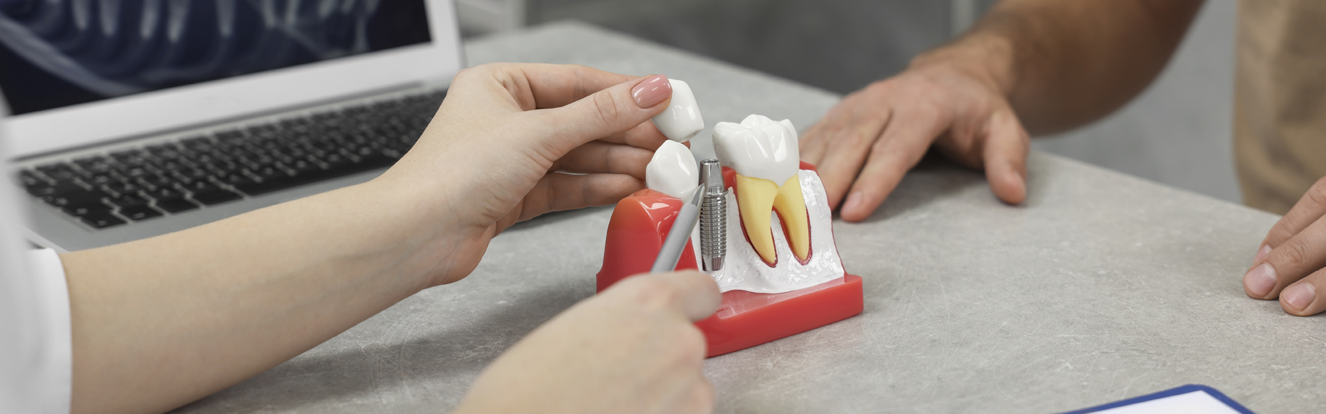 Dental Bridges vs. Implants: Choosing Your Tooth Replacement