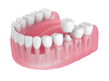 Dental Crown Preparations- Does It Hurt