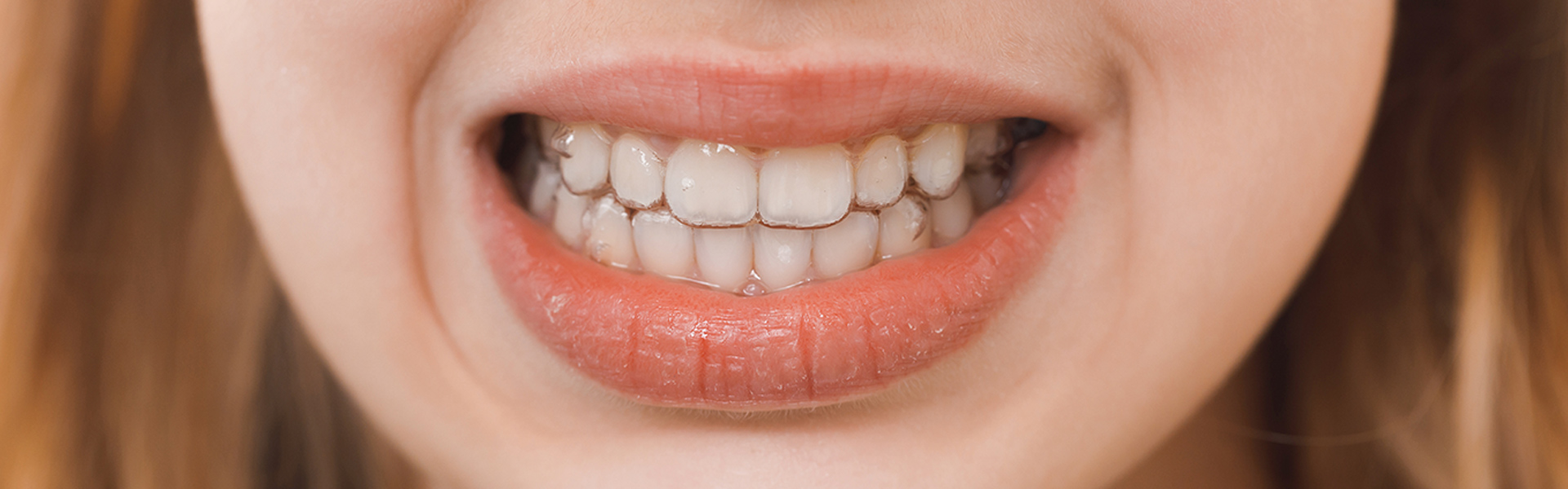 How to Get Rid of Plaque and Keep Your Teeth Shining