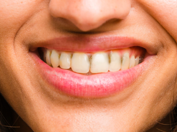 Sudden Brown Stains on Teeth: Causes and Solutions