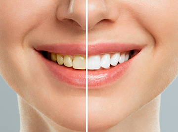 What Your Tooth Shade Says About Your Oral Health